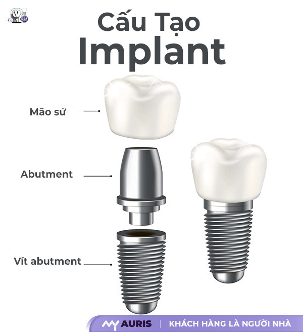 Anatomy of Implant Structure: From Materials to Procedure - My Auris ...